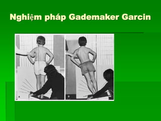 Nghiệm pháp Gademaker Garcin
 