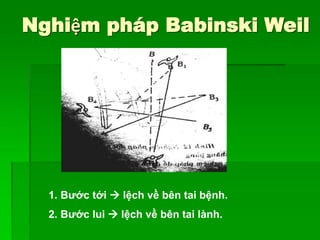 Nghiệm pháp Babinski Weil
1. Bước tới  lệch về bên tai bệnh.
2. Bước lui  lệch về bên tai lành.
 
