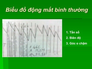 Biểu đồ động mắt bình thường
1. Tần số
2. Biên độ
3. Góc α chậm
 
