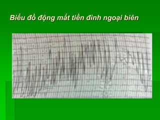 Biểu đồ động mắt tiền đình ngoại biên
 