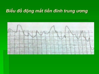 Biểu đồ động mắt tiền đình trung ương
 