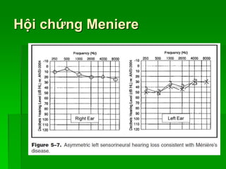 Hội chứng Meniere
 