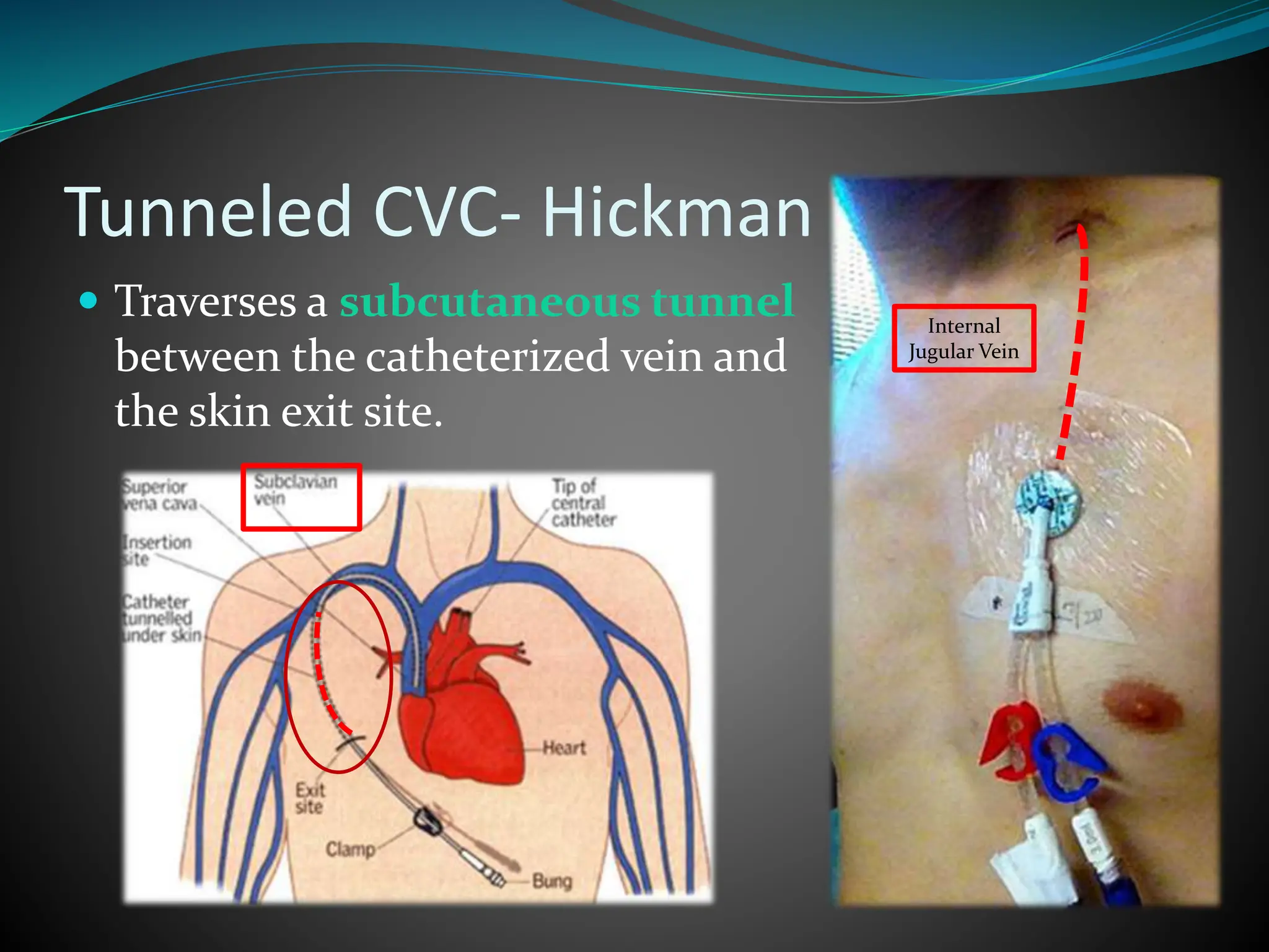 Hickman Catheter An Overview Details About Hickman Insertion Care Hickman Catheter An Overview Details About Hickman Insertion Care