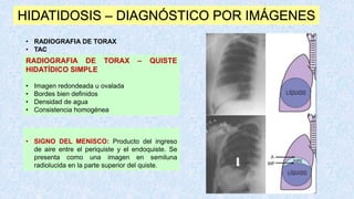 HIDATIDOSIS – DIAGNÓSTICO POR IMÁGENES
• RADIOGRAFIA DE TORAX
• TAC
RADIOGRAFIA DE TORAX – QUISTE
HIDATÍDICO SIMPLE
• Imagen redondeada u ovalada
• Bordes bien definidos
• Densidad de agua
• Consistencia homogénea
• SIGNO DEL MENISCO: Producto del ingreso
de aire entre el periquiste y el endoquiste. Se
presenta como una imagen en semiluna
radiolucida en la parte superior del quiste.
 