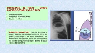 RADIOGRAFIA DE TORAX – QUISTE
HIDATÍDICO COMPLICADO O ROTA
• Nivel hidroaereo
• Imagen de aspecto tumoral
• Cavidad residual
• SIGNO DEL CAMALOTE : Cuando se rompe el
quiste produce eliminación parcial del fluido del
quiste dando lugar a un nivel hidroaereo, las
membranas colapsadas flotan en la superficie
del liquido configurando el signo de lirio de agua
o signo del camalote
 