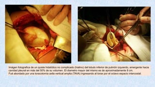 Imágen fotografica de un quiste hidatídico no complicado (hialino) del lobulo inferior de pulmón izquierdo, emergente hacia
cavidad pleural en más del 50% de su volumen. El diametro mayor del mismo es de aproximadamente 8 cm.
Fué abordado por una toracotomía axila vertical amplia (TAVA) ingresando al torax por el octavo espacio intercostal.
 