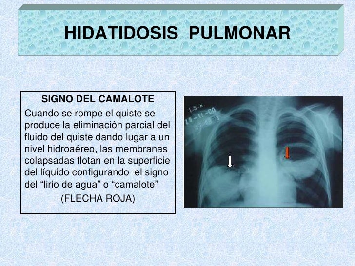 Hidatidosis Heptica En Imagenologa Slideshare Hidatidosis Heptica En Imagenologa Slideshare