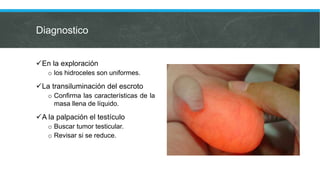 Diagnostico
En la exploración
o los hidroceles son uniformes.
La transiluminación del escroto
o Confirma las características de la
masa llena de líquido.
A la palpación el testículo
o Buscar tumor testicular.
o Revisar si se reduce.
 