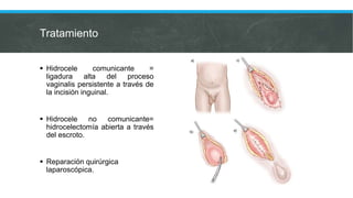 Tratamiento
 Hidrocele comunicante =
ligadura alta del proceso
vaginalis persistente a través de
la incisión inguinal.
 Hidrocele no comunicante=
hidrocelectomía abierta a través
del escroto.
 Reparación quirúrgica
laparoscópica.
 