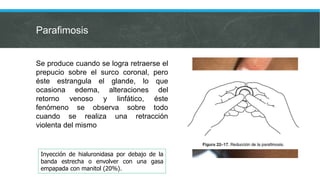 Parafimosis
Se produce cuando se logra retraerse el
prepucio sobre el surco coronal, pero
éste estrangula el glande, lo que
ocasiona edema, alteraciones del
retorno venoso y linfático, éste
fenómeno se observa sobre todo
cuando se realiza una retracción
violenta del mismo
Inyección de hialuronidasa por debajo de la
banda estrecha o envolver con una gasa
empapada con manitol (20%).
 