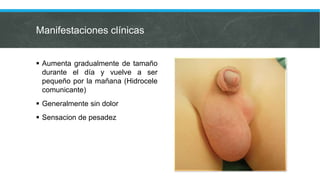 Manifestaciones clínicas
 Aumenta gradualmente de tamaño
durante el día y vuelve a ser
pequeño por la mañana (Hidrocele
comunicante)
 Generalmente sin dolor
 Sensacion de pesadez
 