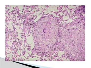 Hid_Pulmonary Tuberculosis.pptx medicine