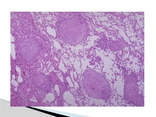 Hid_Pulmonary Tuberculosis.pptx medicine