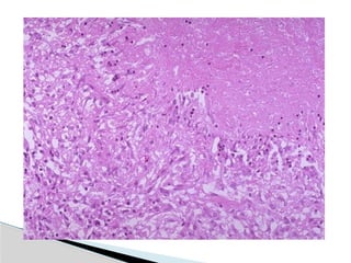 Hid_Pulmonary Tuberculosis.pptx medicine