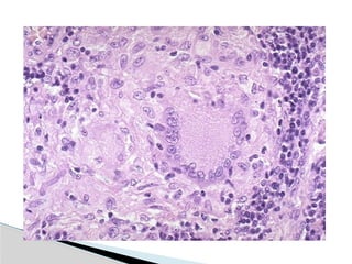 Hid_Pulmonary Tuberculosis.pptx medicine