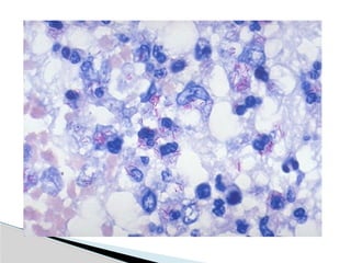 Hid_Pulmonary Tuberculosis.pptx medicine