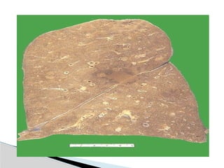 Hid_Pulmonary Tuberculosis.pptx medicine