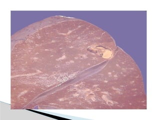 Hid_Pulmonary Tuberculosis.pptx medicine