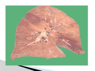 Hid_Pulmonary Tuberculosis.pptx medicine