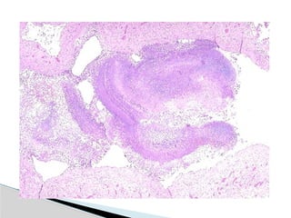 Hid_Pulmonary Tuberculosis.pptx medicine