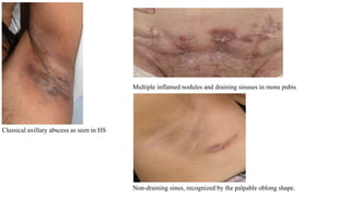 Newer Insights on Hidradenitis Suppurativa.pptx