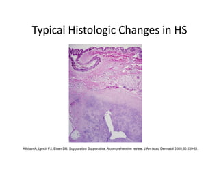 Typical Histologic Changes in HS 




Alikhan A, Lynch PJ, Eisen DB. Suppurativa Suppurativa: A comprehensive review. J Am Acad Dermatol 2009;60:539-61.
 