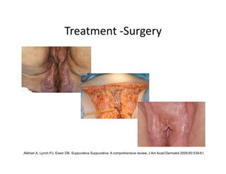 Treatment ‐Surgery 




Alikhan A, Lynch PJ, Eisen DB. Suppurativa Suppurativa: A comprehensive review. J Am Acad Dermatol 2009;60:539-61.
 