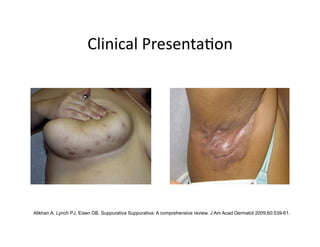 Clinical Presenta(on 




Alikhan A, Lynch PJ, Eisen DB. Suppurativa Suppurativa: A comprehensive review. J Am Acad Dermatol 2009;60:539-61.
 