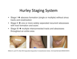 Hurley Staging System 
  Stage I  abscess formation (single or multiple) without sinus
   tracts and cicatrization

  Stage II  one or more widely separated recurrent abscesses
   with tract formation and scars 

  Stage III  multiple interconnected tracts and abscesses
   throughout an entire area 





Alikhan A, Lynch PJ, Eisen DB. Suppurativa Suppurativa: A comprehensive review. J Am Acad Dermatol 2009;60:539-61.
 