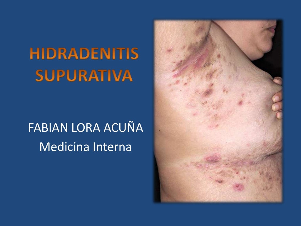 Hidradenitis supurativa