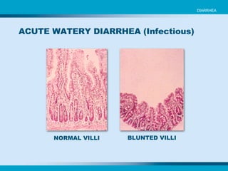 NORMAL VILLI BLUNTED VILLI ACUTE WATERY DIARRHEA (Infectious)  DIARRHEA 