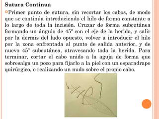 Sutura Continua
Primer punto de sutura, sin recortar los cabos, de modo
que se continúa introduciendo el hilo de forma constante a
lo largo de toda la incisión. Cruzar de forma subcutánea
formando un ángulo de 45º con el eje de la herida, y salir
por la dermis del lado opuesto, volver a introducir el hilo
por la zona enfrentada al punto de salida anterior, y de
nuevo 45º subcutánea, atravesando toda la herida. Para
terminar, cortar el cabo unido a la aguja de forma que
sobresalga un poco para fijarlo a la piel con un esparadrapo
quirúrgico, o realizando un nudo sobre el propio cabo.
 
