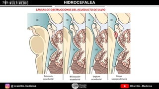 @ rcarrillo.medicina RCarrillo - Medicina
HIDROCEFALEA
CAUSAS DE OBSTRUCCIONES DEL ACUEDUCTO DE SILVIO
Estenosis
acueductal
Bifurcación
acueductal
Gliosis
subependimaria
Septum
acueductal
 