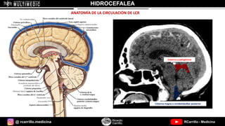 @ rcarrillo.medicina RCarrillo - Medicina
HIDROCEFALEA
ANATOMÍA DE LA CIRCULACIÓN DE LCR
Cisterna cuadrigémica
Cisterna magna o cerebelobulbar posterior
 