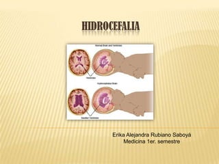Hidrocefalia Slide 1