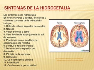 Hidrocefalia Slide 10
