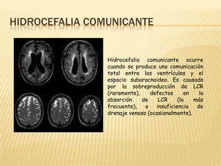 Hidrocefalia Slide 5