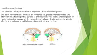 La malformación de Chiari
tipo II se caracteriza por hidrocefalia progresiva con un mielomeningocele.
Esta lesión representa una anomalía del rombencéfalo, probablemente debida a una
alteración de la flexión pontina durante la embriogénesis, y da lugar a una elongación del
cuarto ventrículo e incurvación del tronco del encéfalo con desplazamiento del vermis
inferior, la protuberancia y el bulbo raquídeo hacia el canal cervical.
 