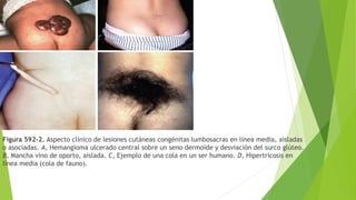 Figura 592-2. Aspecto clínico de lesiones cutáneas congénitas lumbosacras en línea media, aisladas
o asociadas. A, Hemangioma ulcerado central sobre un seno dermoide y desviación del surco glúteo.
B, Mancha vino de oporto, aislada. C, Ejemplo de una cola en un ser humano. D, Hipertricosis en
línea media (cola de fauno).
 