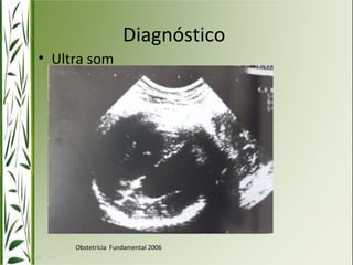 Diagnóstico 
• Ultra som 
Obstetrícia Fundamental 2006 
 