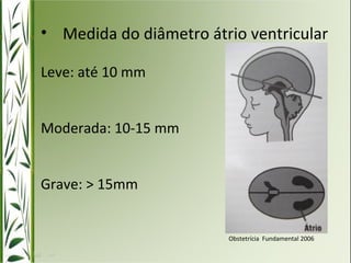 • Medida do diâmetro átrio ventricular 
Leve: até 10 mm 
Moderada: 10-15 mm 
Grave: > 15mm 
Obstetrícia Fundamental 2006 
 