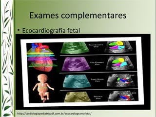 Exames complementares 
• Ecocardiografia fetal 
http://cardiologiapediatricadf.com.br/ecocardiogramafetal/ 
 