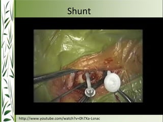 Shunt 
http://www.youtube.com/watch?v=0h7Xa-Lsnac 
 