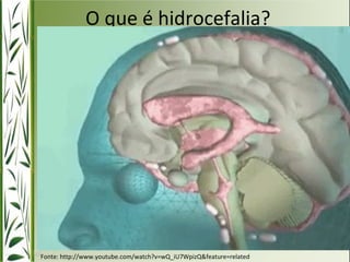 O que é hidrocefalia? 
Fonte: http://www.youtube.com/watch?v=wQ_iU7WpizQ&feature=related 
 