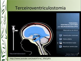 Terceiroventriculostomia 
http://www.youtube.com/watch?v=w_-EfoCyJFU 
 
