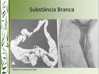 Substância Branca 
Obstetrícia Fundamental 2006 
 