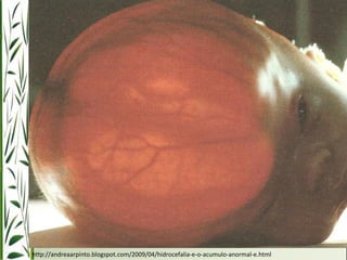 http://andreaarpinto.blogspot.com/2009/04/hidrocefalia-e-o-acumulo-anormal-e.html 
 