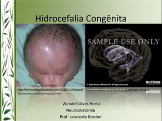 Hidrocefalia Congênita 
http://mriocndido.blogspot.com/2010/11/hidrocef 
alia-conheca-mais-um-pouco.html 
www.youtube.com/watch?v=0jSWjOBIIUI&NR=1 
Wendell Alves Horta 
Neuroanatomia 
Prof. Leonardo Bordoni 
 
