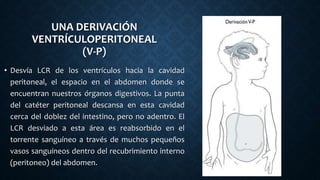 UNA DERIVACIÓN
VENTRÍCULOPERITONEAL
(V-P)
• Desvía LCR de los ventrículos hacia la cavidad
peritoneal, el espacio en el abdomen donde se
encuentran nuestros órganos digestivos. La punta
del catéter peritoneal descansa en esta cavidad
cerca del doblez del intestino, pero no adentro. El
LCR desviado a esta área es reabsorbido en el
torrente sanguíneo a través de muchos pequeños
vasos sanguíneos dentro del recubrimiento interno
(peritoneo) del abdomen.
 