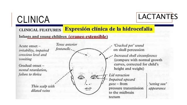 Hidrocefalia